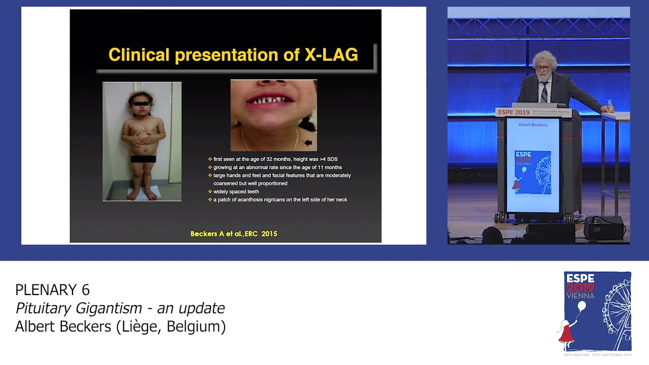 ESPE 2019 Plenary 6: Pituitary Gigantism - an update