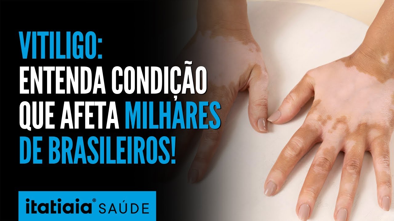 Vitiligo tem cura? Entenda doen&ccedil;a autoimune que afeta milhares de brasileiros