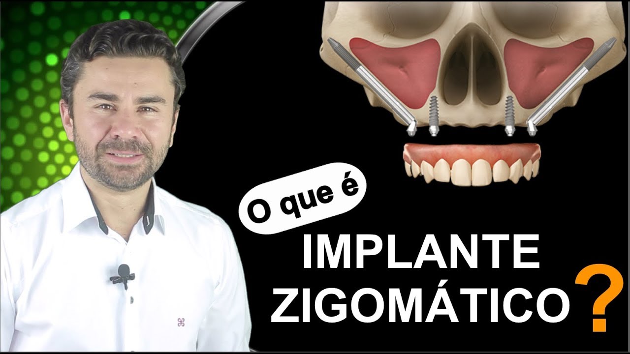 O que é Implante Zigomático? Uma Explicação Rápida e Direta