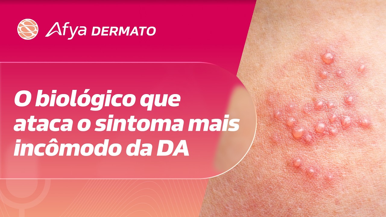 Nemolizumab e o foco no prurido: IL-31 em pauta