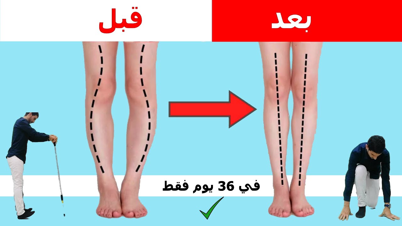 افضل 8 تمارين لعلاج تقوس الساقين للبالغين في شهر | bow legs | علاج تقوس الساقين للخارج