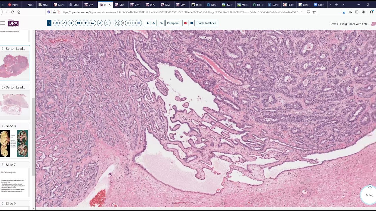 Retiform Sertoli Leydig Cell Tumor of Ovary