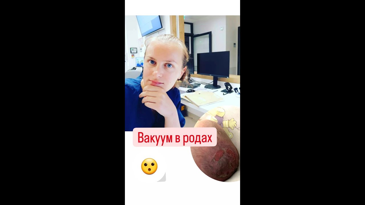 Роды. Можно ли отказаться от вакуум-экстракции? Плоский плодный пузырь
