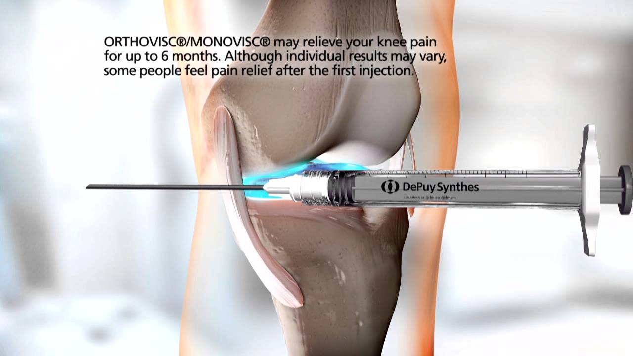 ORTHOVISC®/MONOVISC® Injection Animation