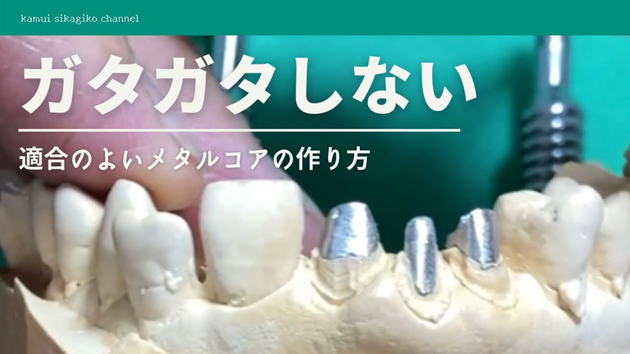 【歯科技工】歯根破折を防ぐメタルコアの作り方
