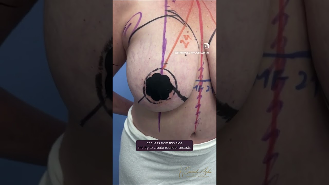 Dermal Bra Suspension Breast Lift, Lipo, and Abdominal Scar Revision