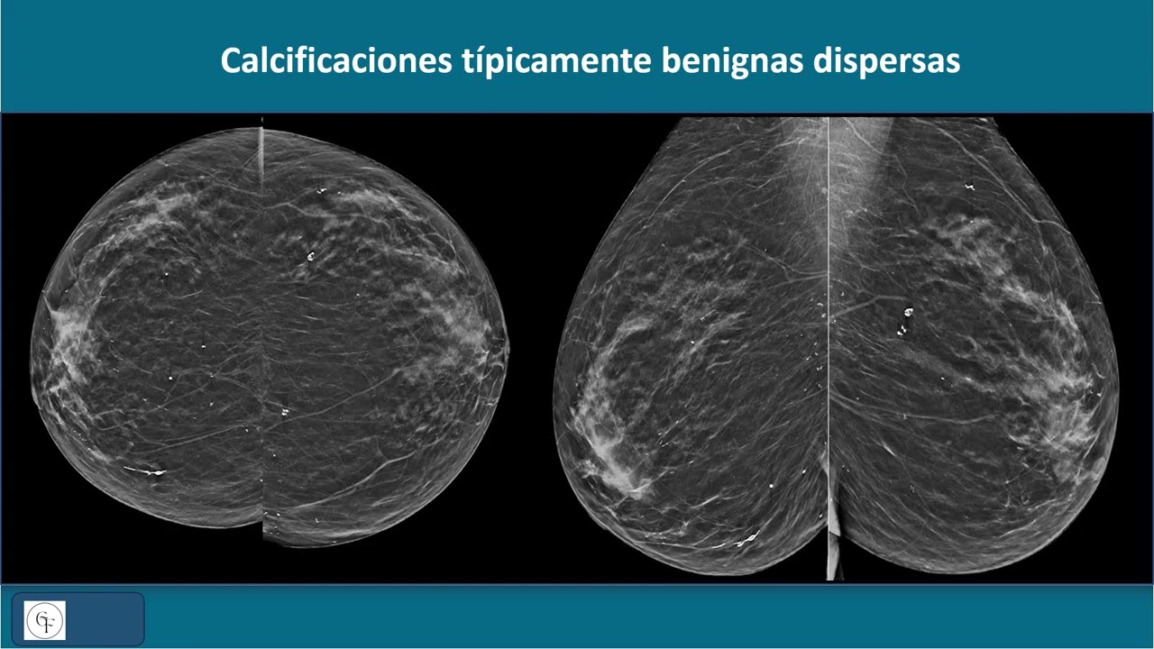 6 BI RADS MX CALCIFICACIONES
