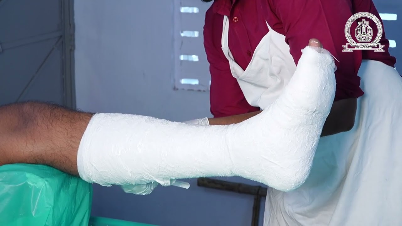 Below Knee (BK) Plaster of Paris (POP) Cast