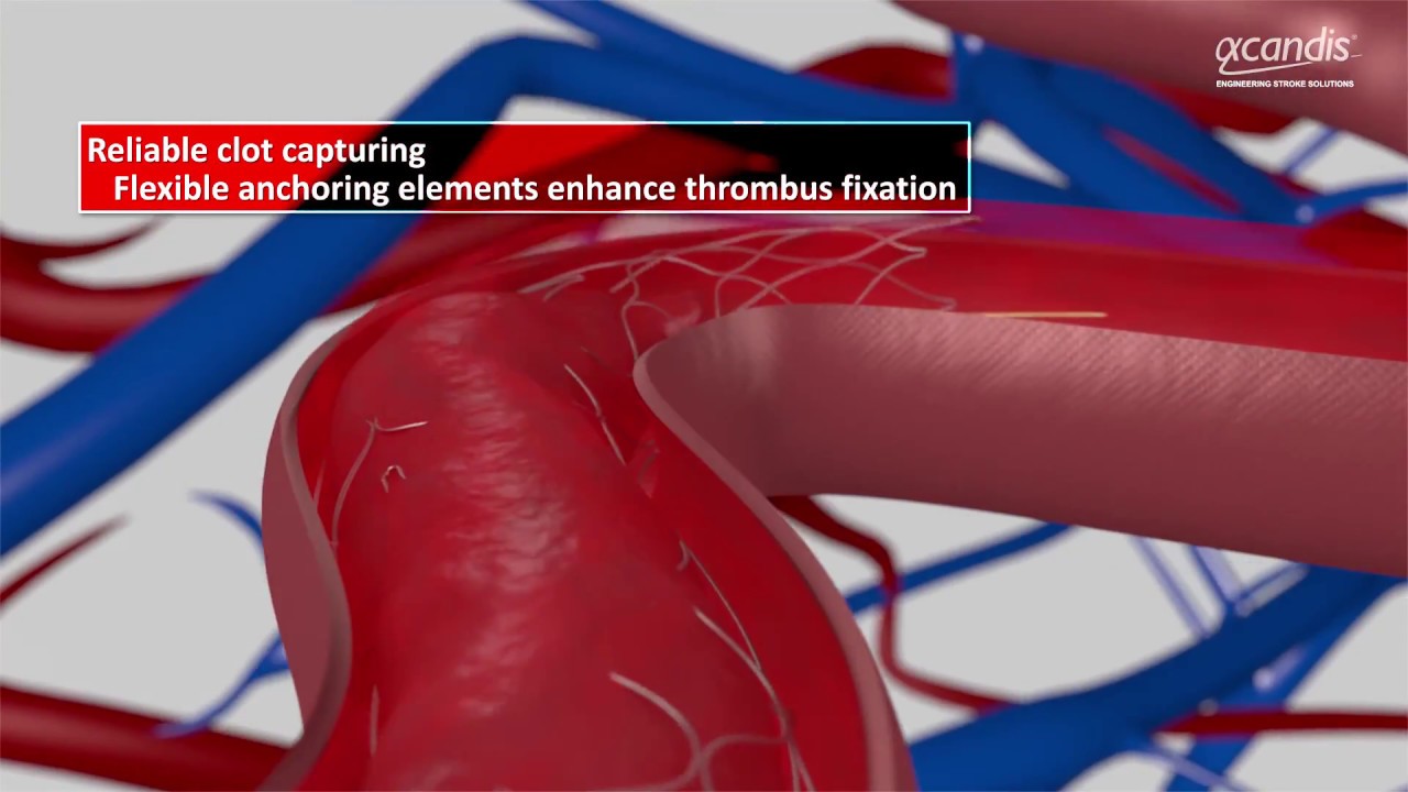 Product Animation Aperio&reg; Thrombectomy Device