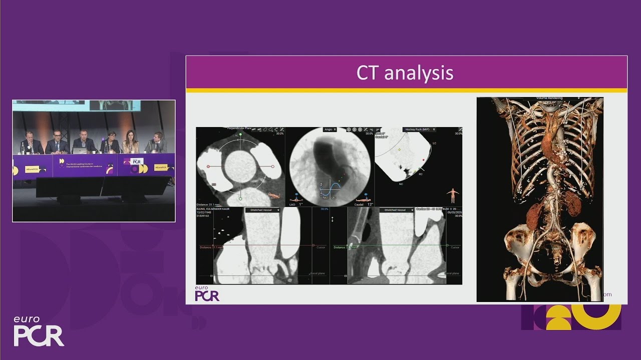 Optimising self-expandable TAVI clinical outcomes without compromise - EuroPCR 2025