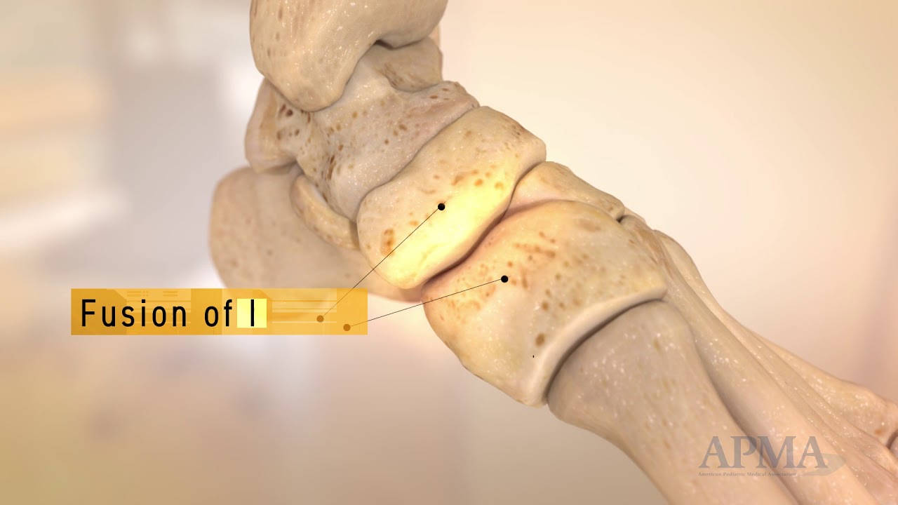 Foot Surgery