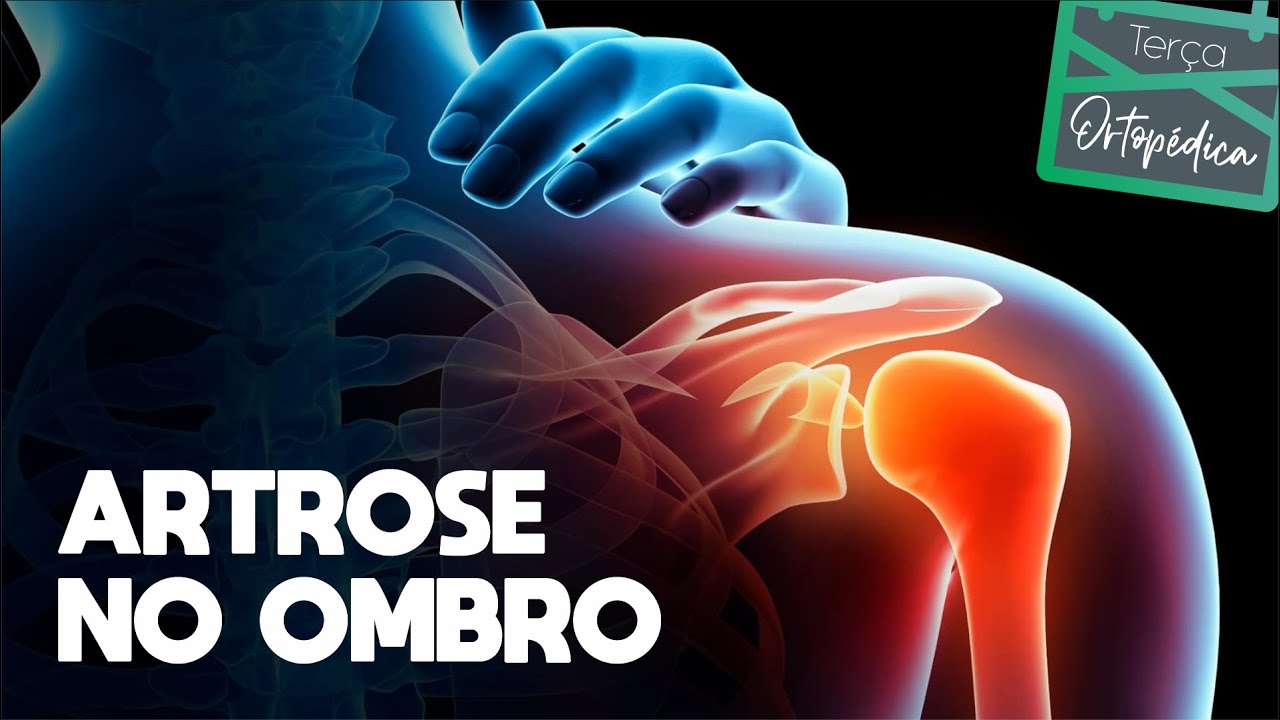 Artrose no Ombro  (Dr. Eric Curi - Ortopedista Ombro e Cotovelo)