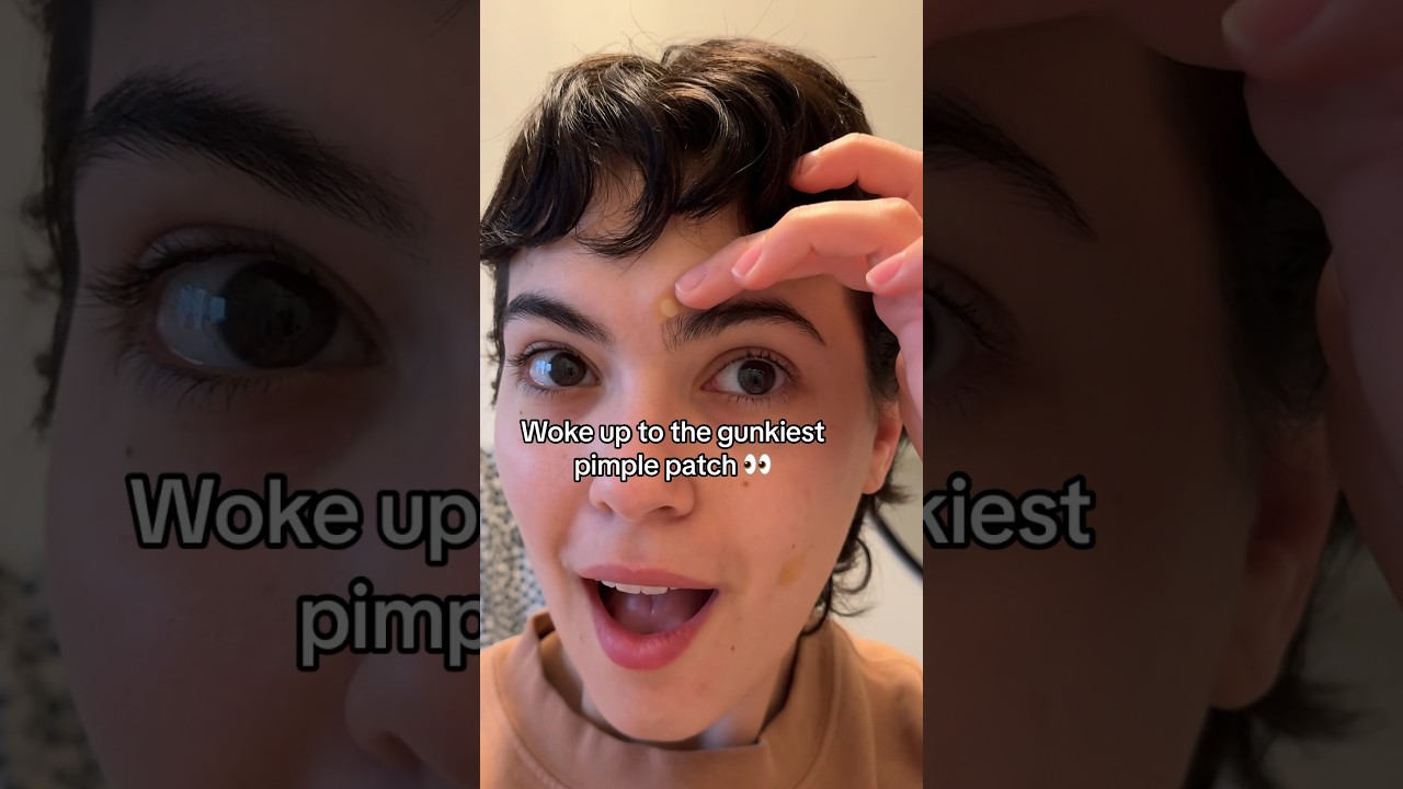 😩 Can&rsquo;t believe this pimple patch peel! 😍🤌 #pimplepatch #pimplesolution