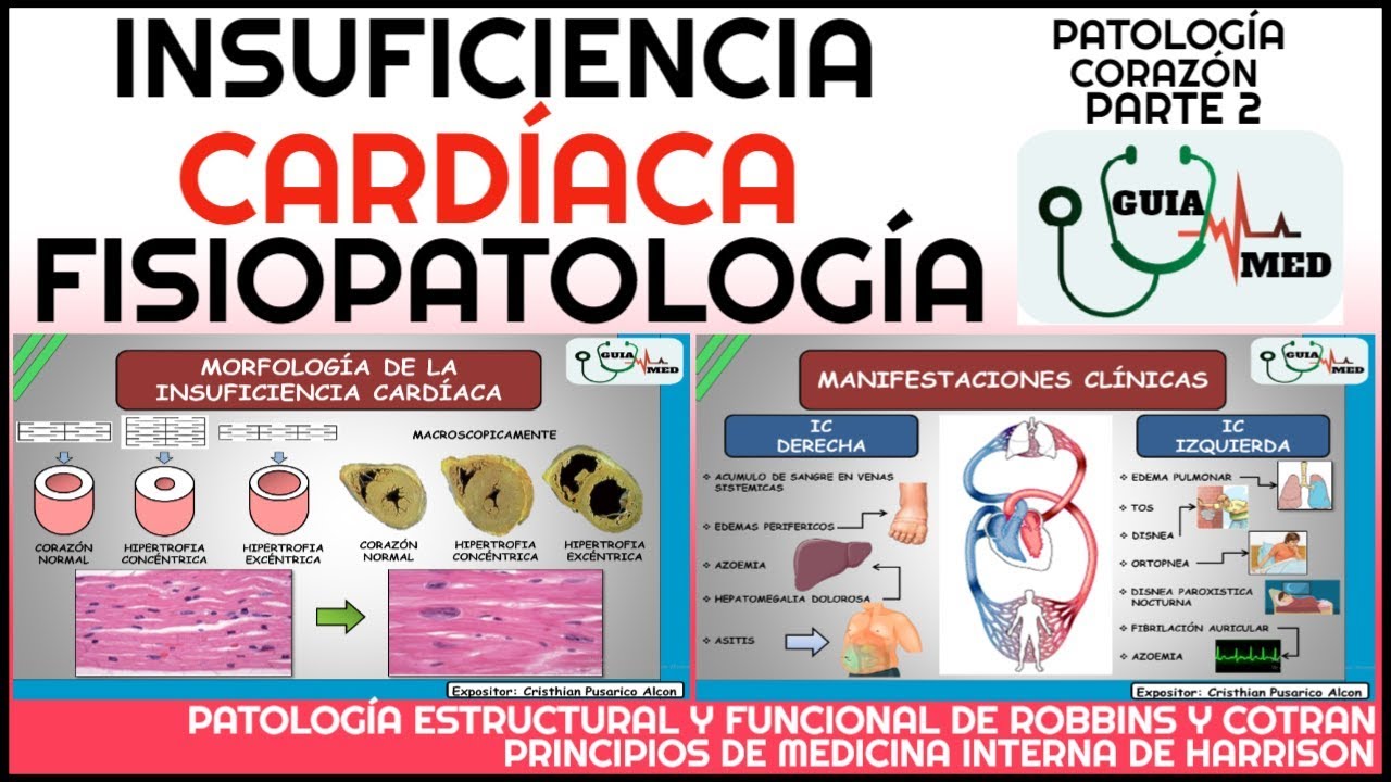INSUFICIENCIA CARDÍACA FISIOPATOLOGÍA | GuiaMed