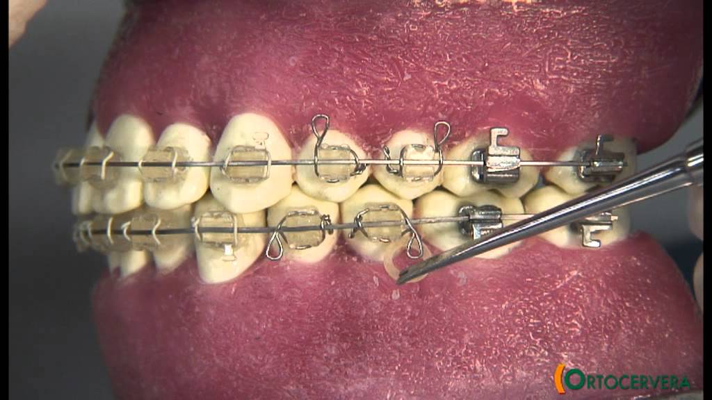 ORTOCERVERA / Ortodoncia: Terminación Dobleces y Elásticos