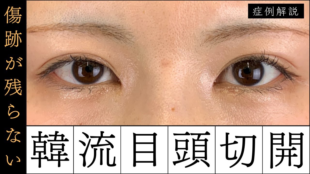 【症例解説】傷跡が残らない！韓流目頭切開ってなに？