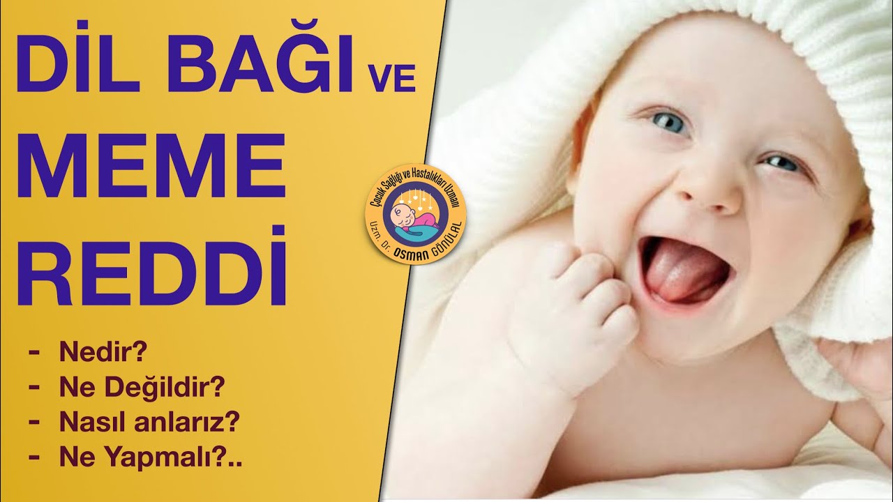 Bebeklerde Dil Bağı ve Beslenme Reddi