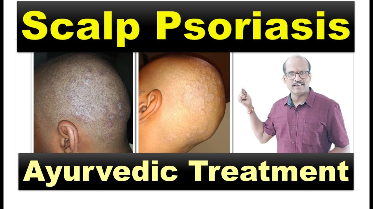 Treating Scalp Psoriasis | Scalp Psoriasis & Ayurveda | Krimighna Therapy| Dr. Mahesh P Savalagimath