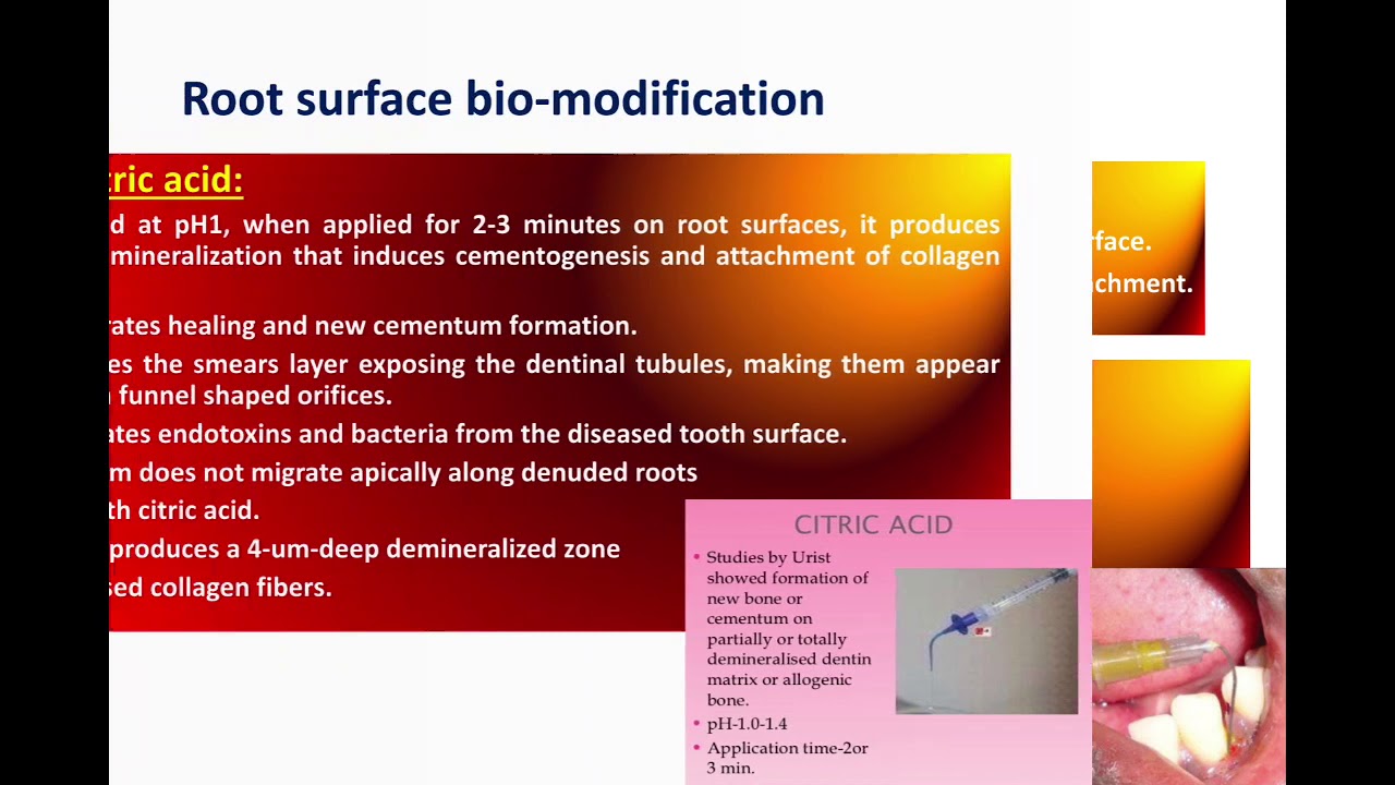Periodontal Regenerative Therapy