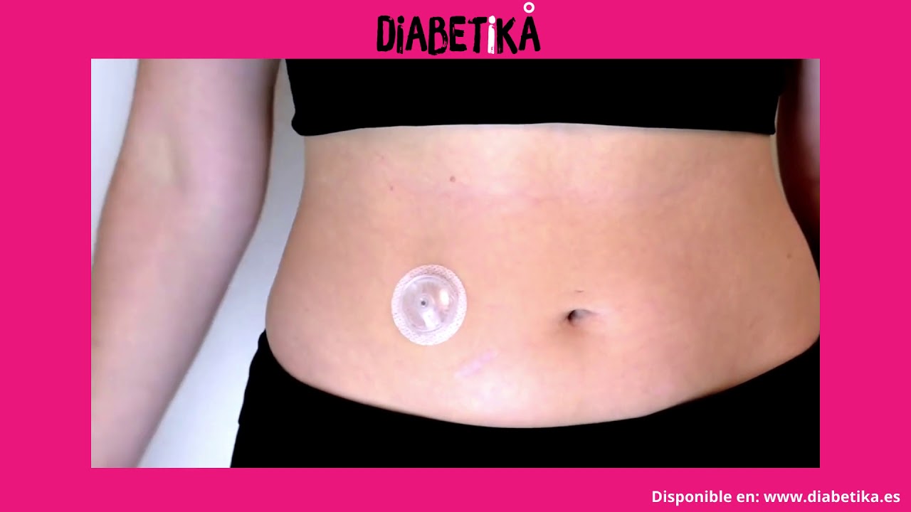 Iport Advance - Medtronic