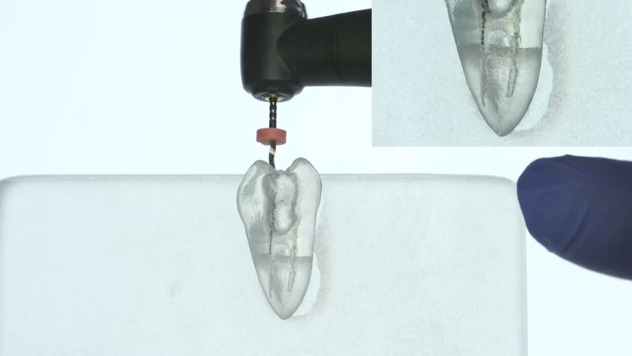 How to deal with LEDGE during endodontic treatment