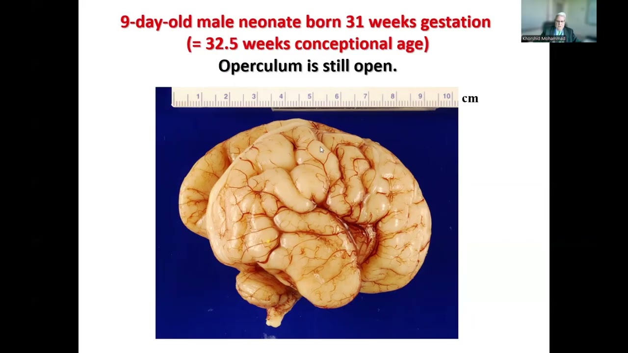 Development of Fissures and Sulci  in the Human Fetal Brain and their Disorders