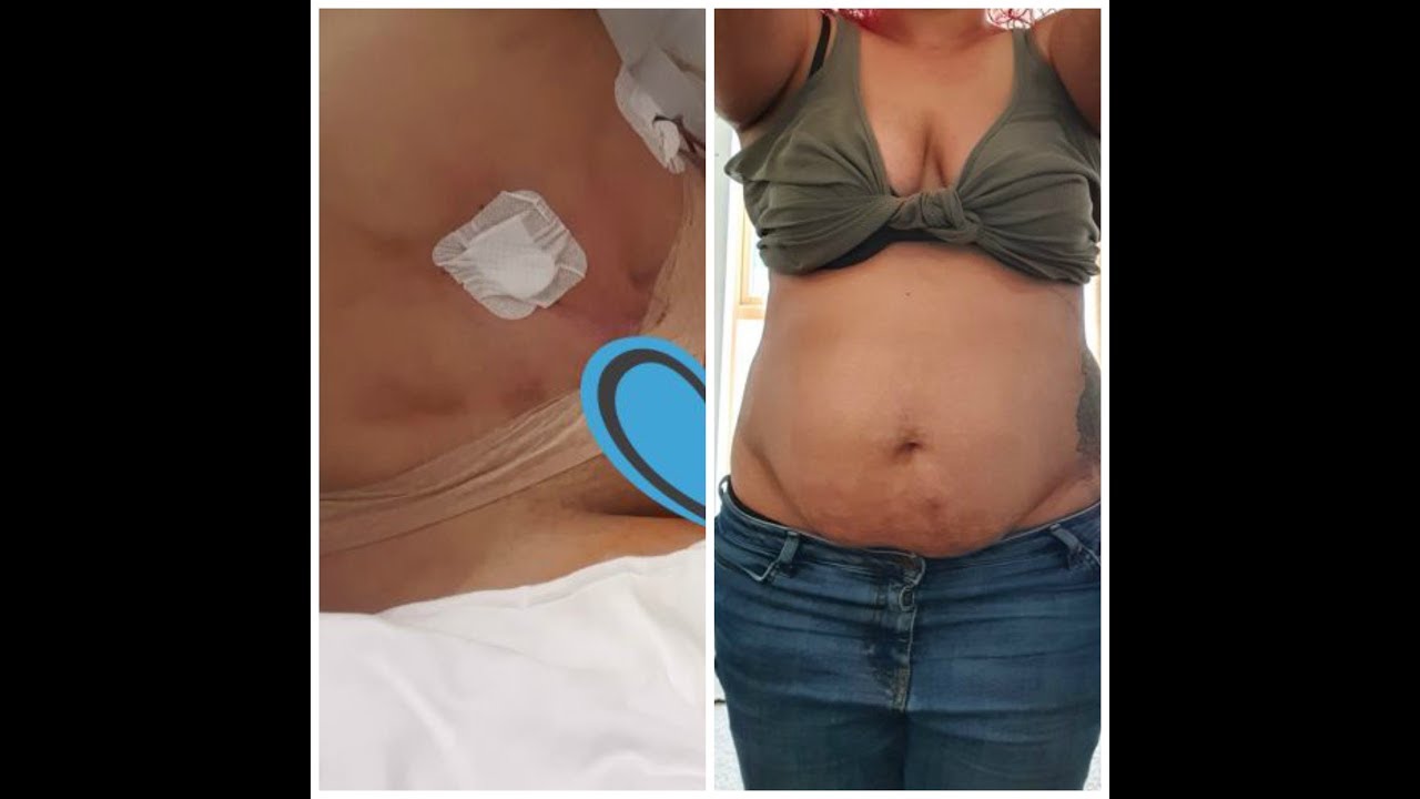 Tummy Tuck in Lithuania with Nordesthetics Part 1