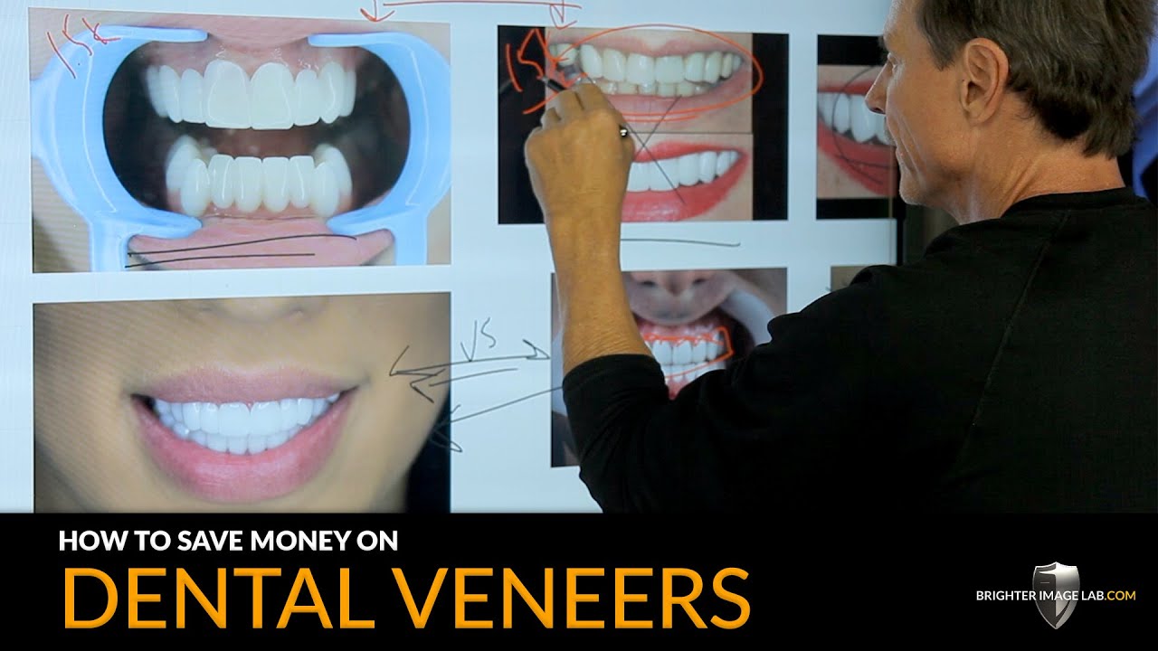 Don't Get Ripped Off on Dental Veneers - $15,000 Cosmetic Dentist vs $1,500 Snap-On Veneers