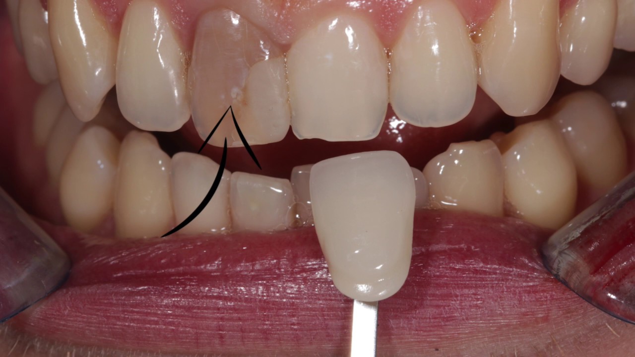 Am pus 3 coroane din ZIRCONIU sub acoperire / Dentistry Hub