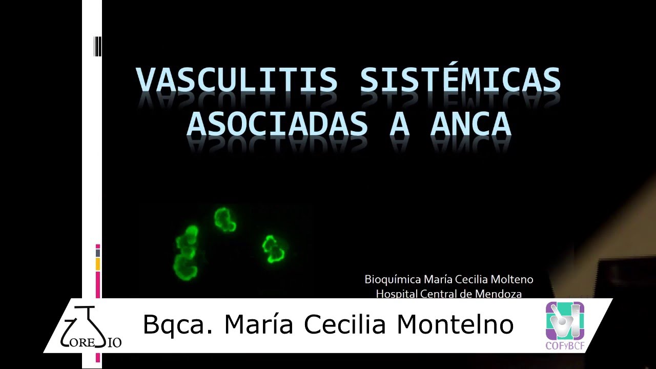 2016/04 - Vasculitis Sistémicas Asociadas a ANCA
