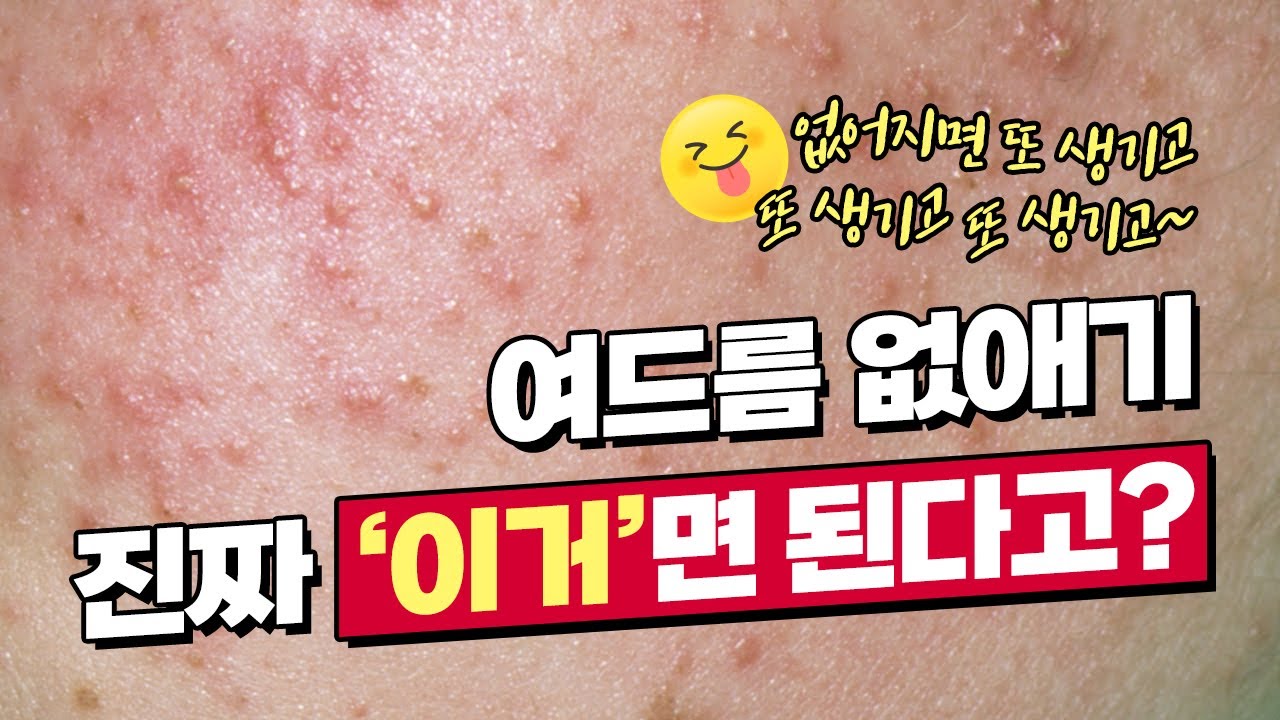 네오빔레이저 여드름치료에 기립박수👏 받는 이유!