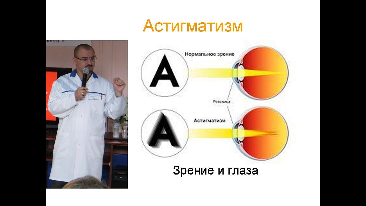 Астигматизм – что это такое?
