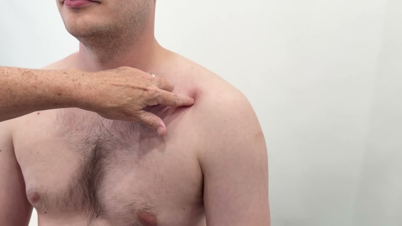 McMaster Medical Acupuncture Program: LU 2 Point Demonstration