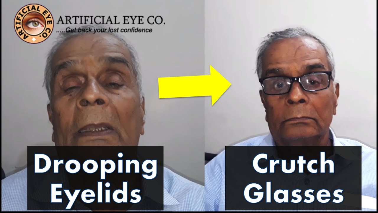 Ptosis management using crutch glass | No surgery required | Dr Sumitra