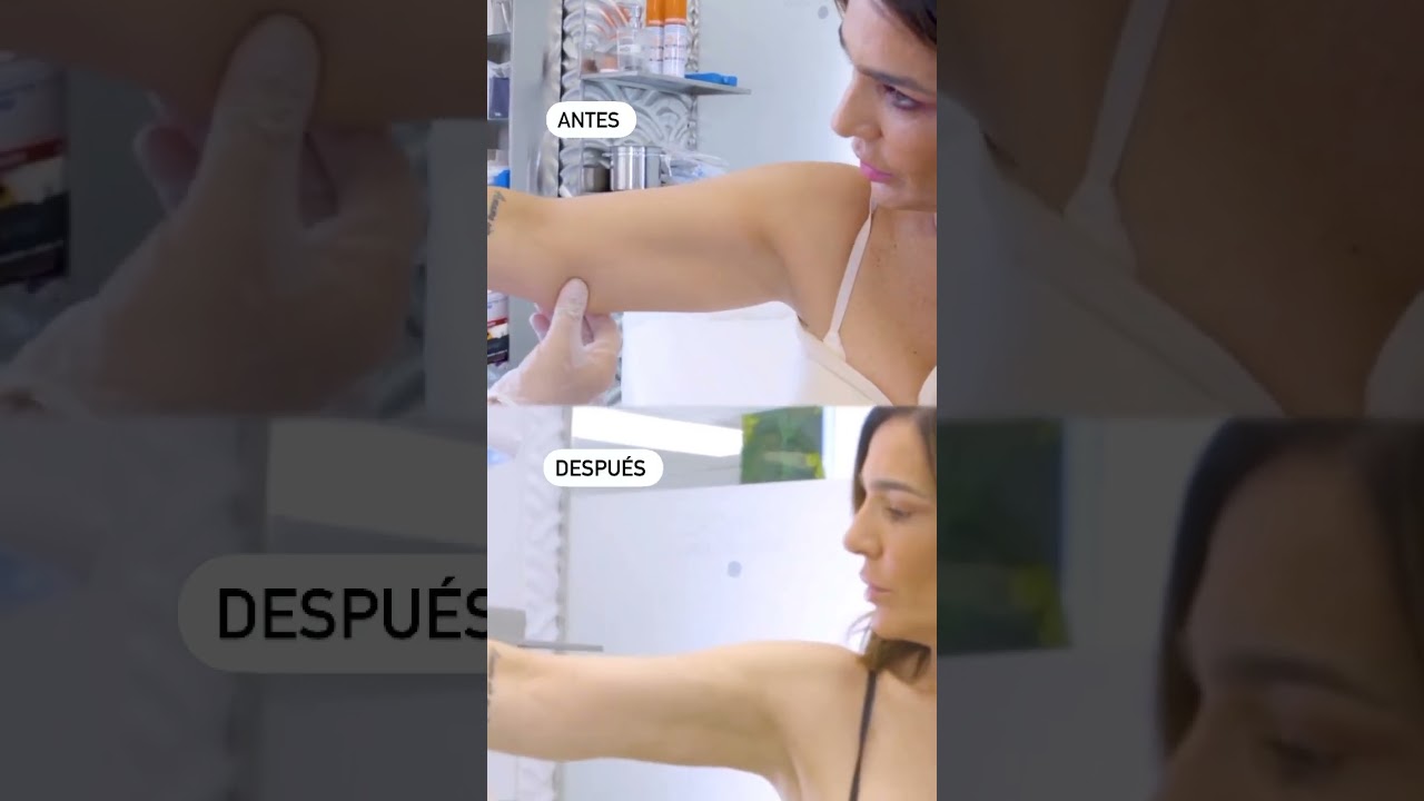 👩🏻&zwj;⚕️👨🏻&zwj;⚕️Y as&iacute; de espectacular es el &laquo;antes y despu&eacute;s&raquo; de nuestra querida #raquelbollo 👸🏽