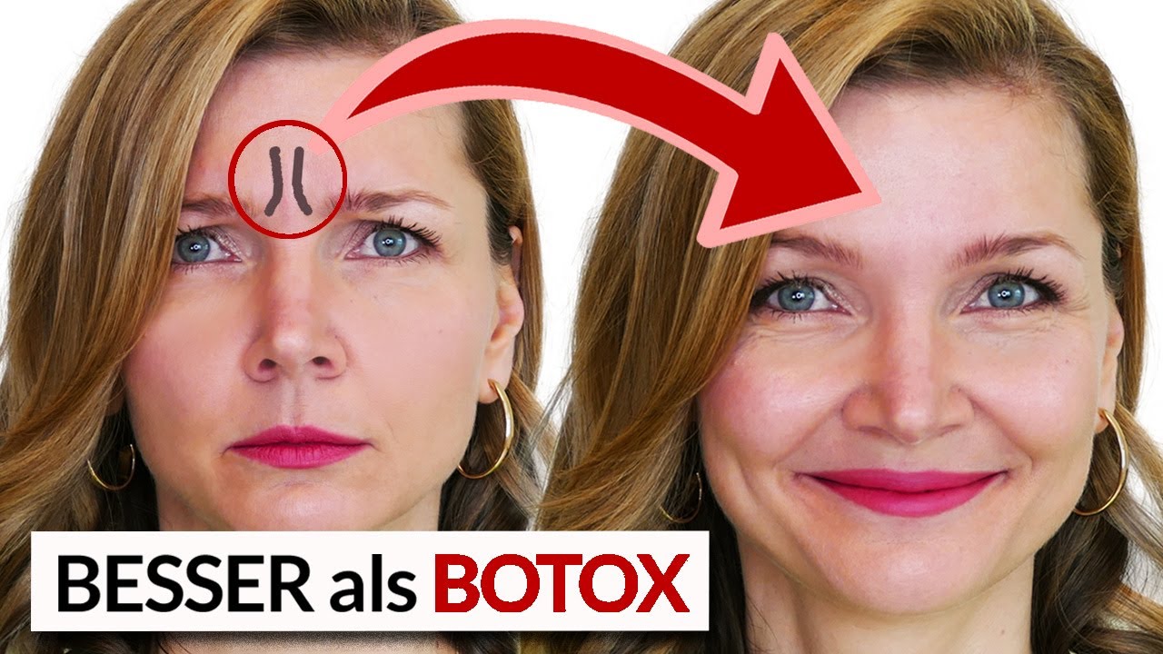 Botox-Wirkung gegen Zornesfalten 🙌 (kaum zu glauben)