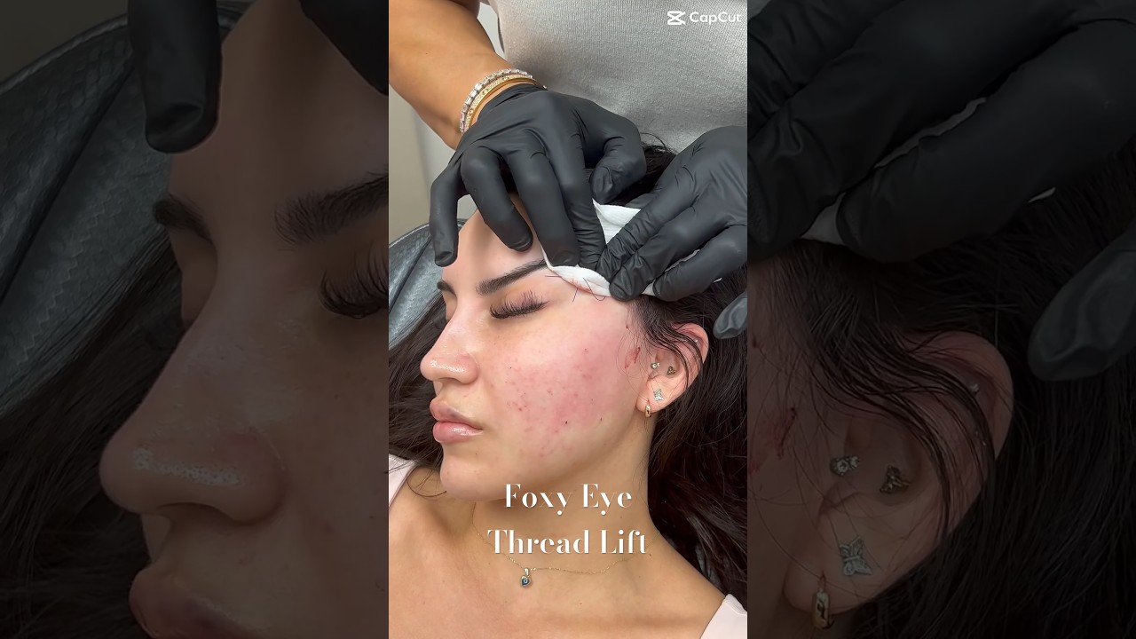 Foxy Eye Thread Lift by Dr Gideon Kwok at Skin Perfect Rancho 🪡 #beauty #threadlift