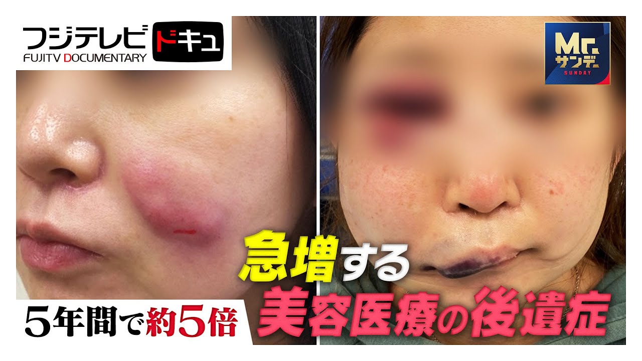 【Mr.サンデー】脂肪吸引直後に意識不明で救急搬送！急増する美容医療&ldquo;後遺症&rdquo;の実態【実録ドキュメント】