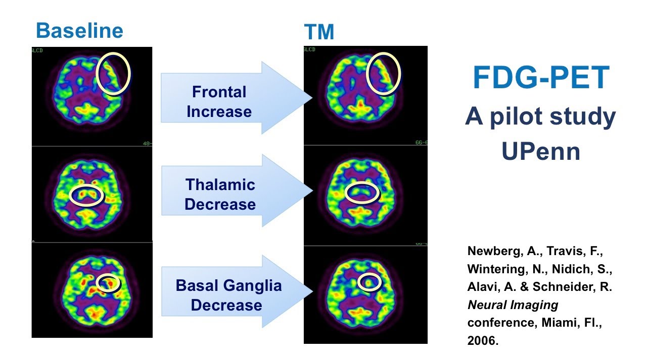 Brain Imaging During Transcendental Meditation