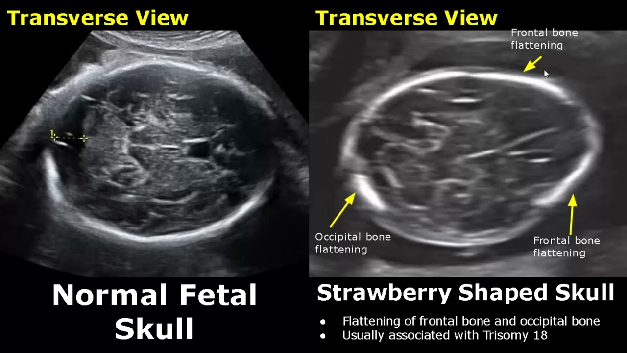 Fetal Head Ultrasound Normal Vs Abnormal Images | Cloverleaf/Lemon/Strawberry Sign Skull USG