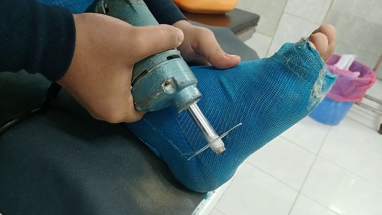 فك الجبس