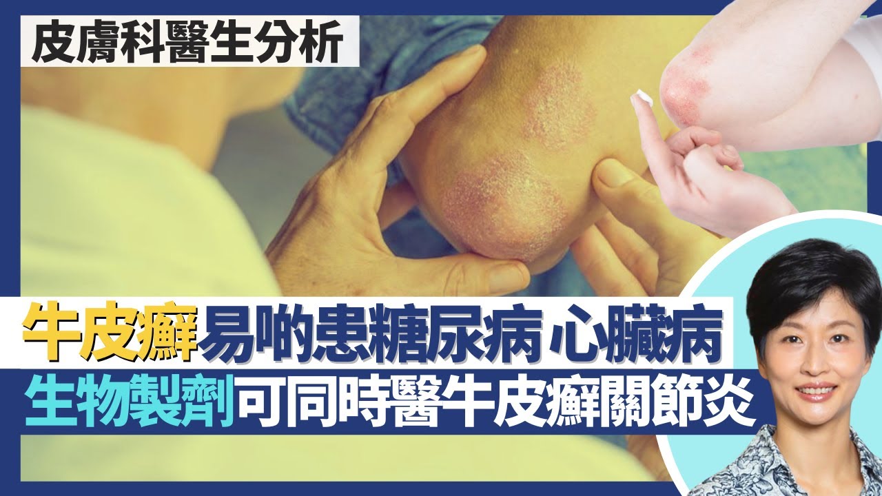 牛皮癬｜銀屑病唔會傳染！牛皮癬患者易啲患糖尿病心臟病？部分生物製劑治療牛皮癬同時醫牛皮癬關節炎！｜王建芳醫生 皮膚科醫生陳厚毅醫生｜人類健康研究所