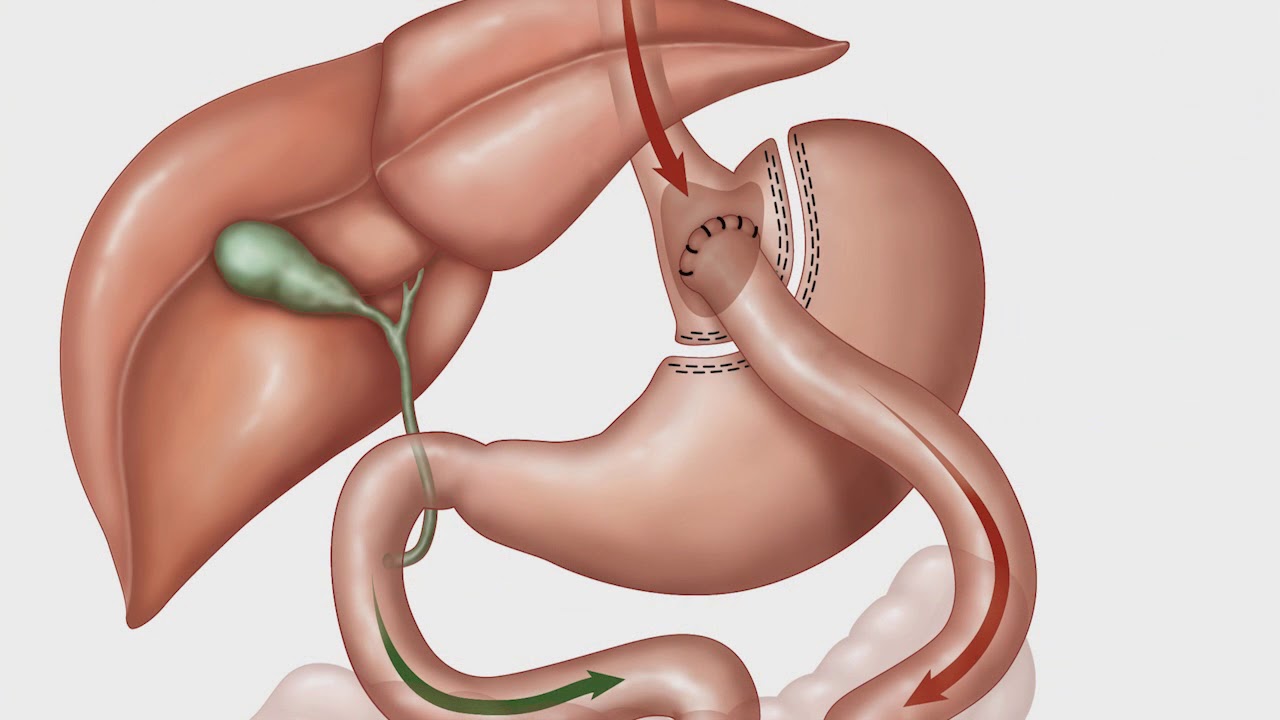Qu'est-ce que la chirurgie bariatrique?