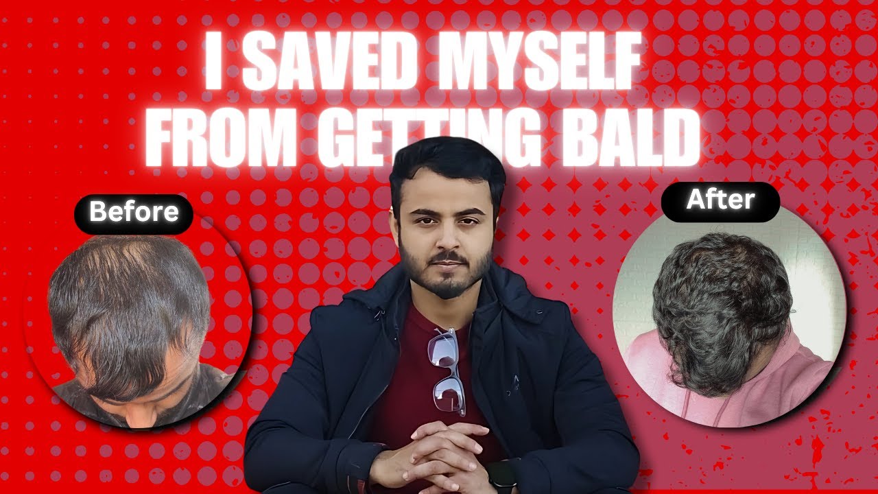 How I Saved Myself From Balding