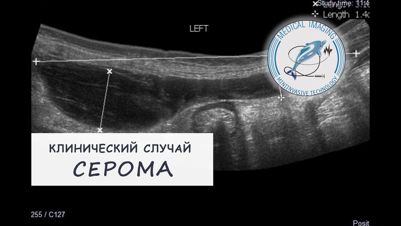 Серома (мобильное УЗИ)