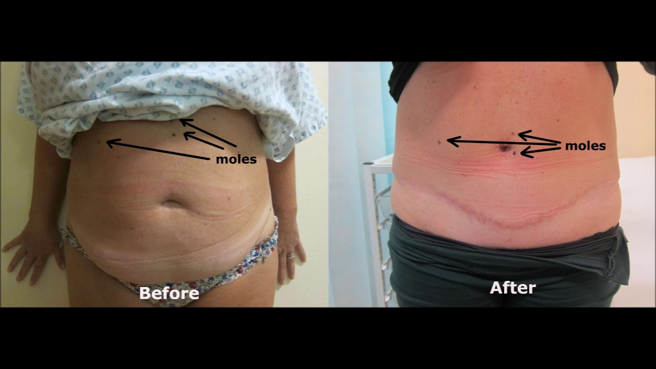 Drains or Glue for Tummy Tuck