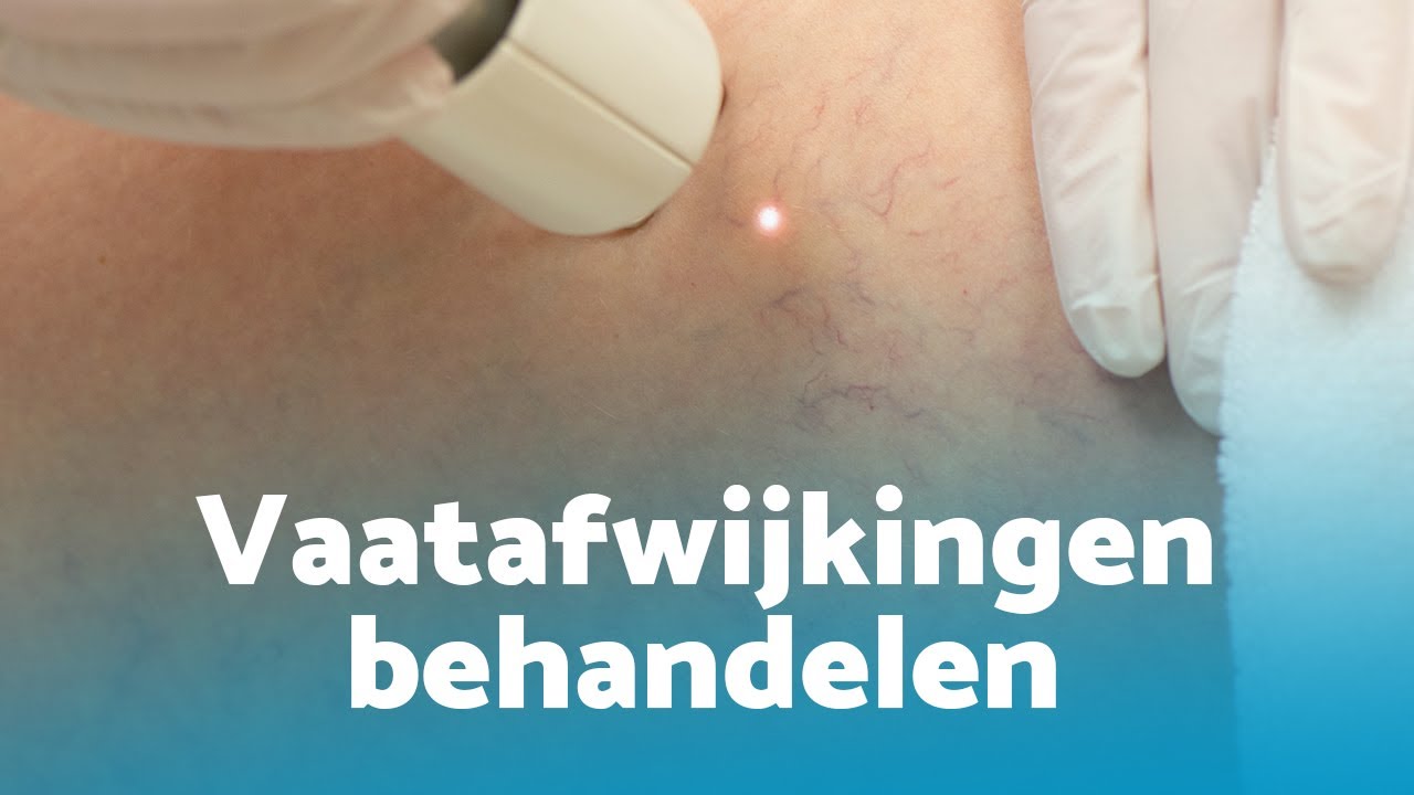 Vaatafwijkingen behandelen 2023: weg met klachten als couperose, rosacea en spataderen!