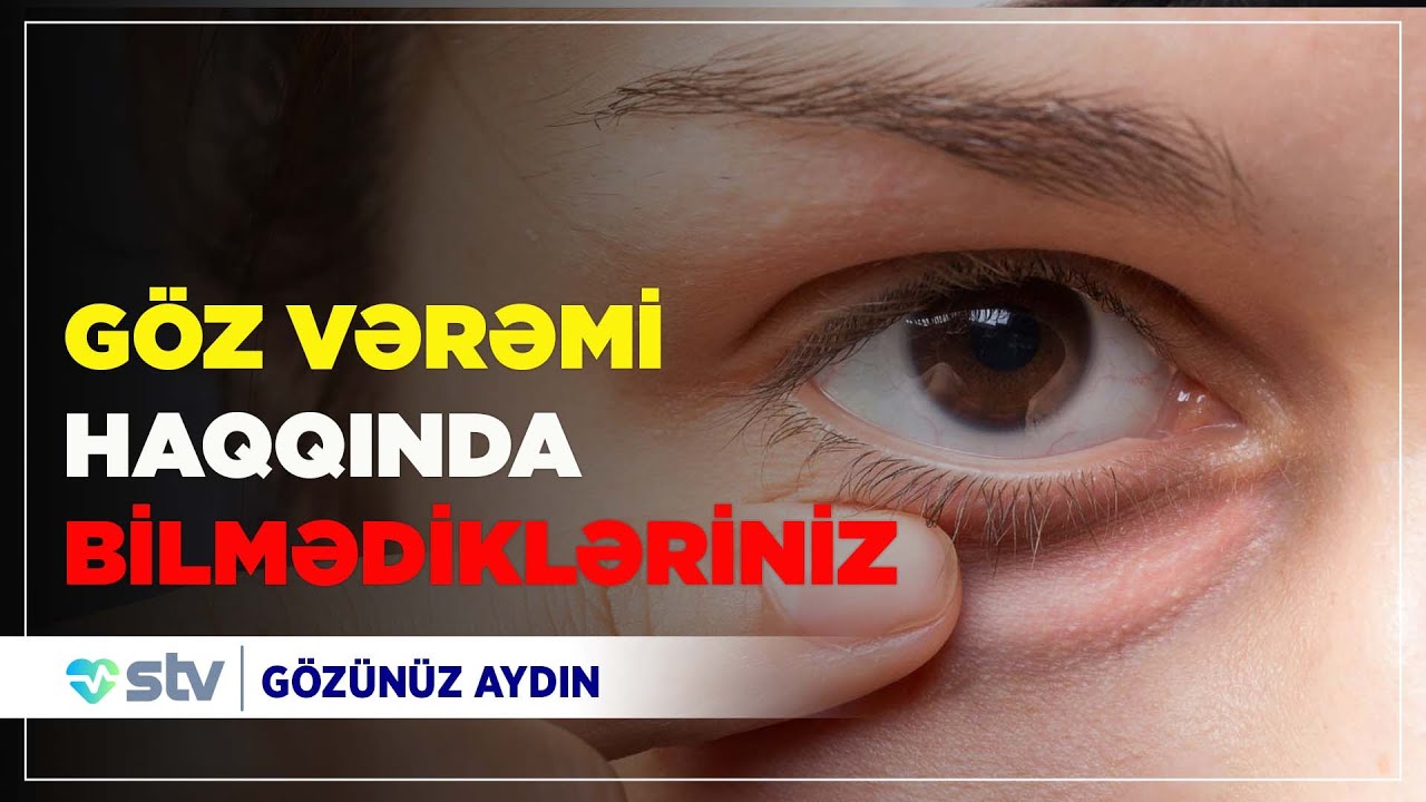 Göz vərəmi - Leyda Kazımova, Tural Qəlbinur, Rəna Həmzəyeva  (03.08.2020)