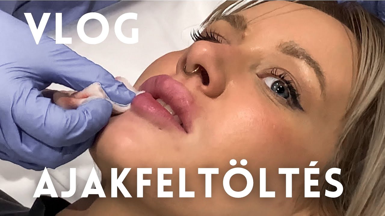 VLOG | HYALURONSAVAS AJAKFELTÖLTÈS #59