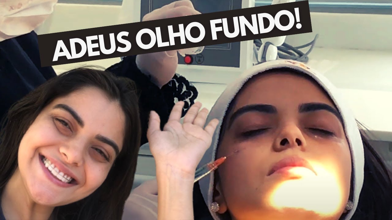 FIZ PREENCHIMENTO NAS MINHAS OLHEIRAS COM ÁCIDO HIALURÔNICO - REALIZEI UM SONHO!